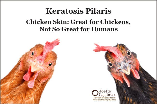 Joette Calabrese, Practical Homeopathy®, Keratosis Pilaris: Chicken Skin Is Great for Chickens, Not So Great for Humans