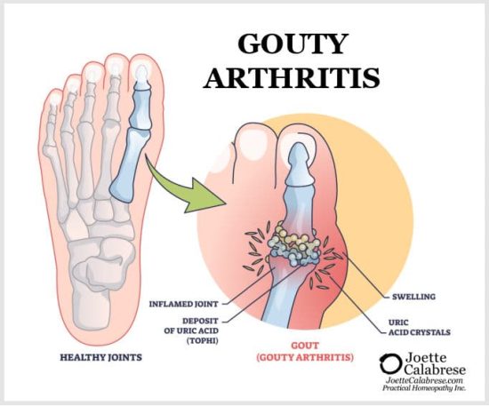 Boomeropathy Gout_INTERNAL