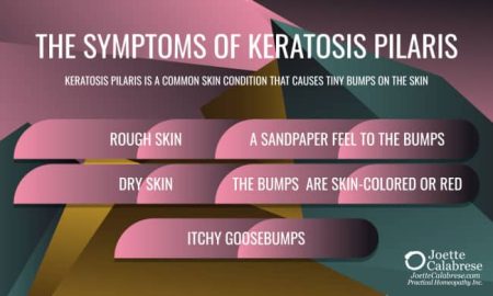 Joette Calabrese, Practical Homeopathy®, Keratosis Pilaris: Chicken Skin Is Great for Chickens, Not So Great for Humans
