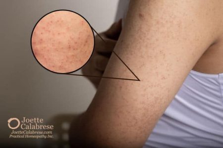 Joette Calabrese, Practical Homeopathy®, Keratosis Pilaris: Chicken Skin Is Great for Chickens, Not So Great for Humans