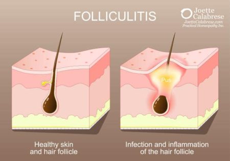 Joette Calabrese, Practical Homeopathy®, Folliculitis